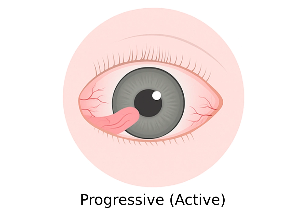 Progressive (Active) Pterygium